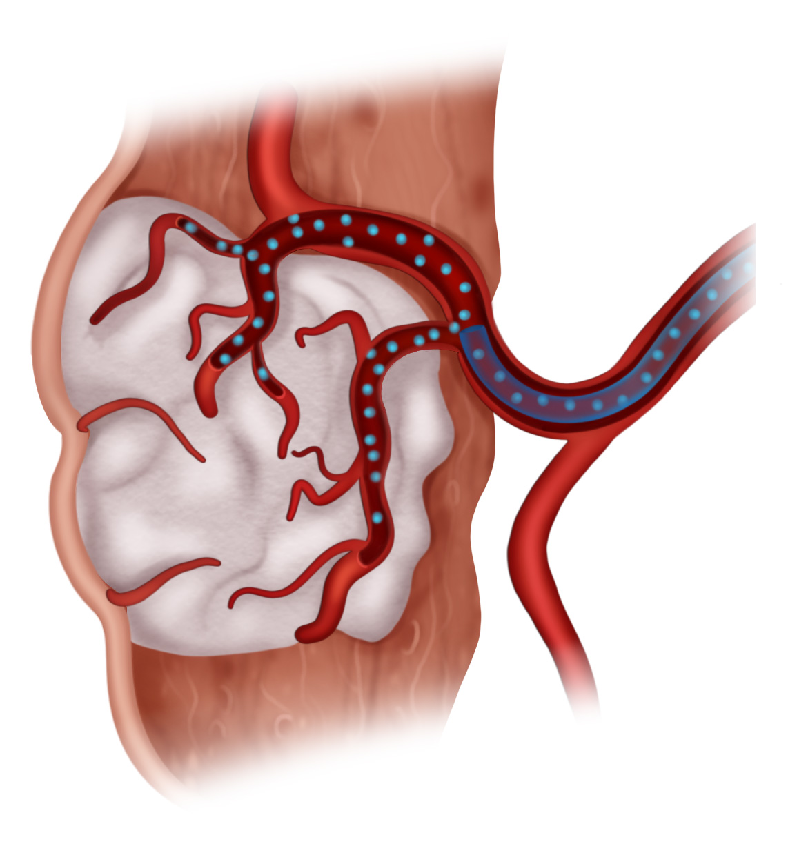 Advancing embolization with purified gelatin